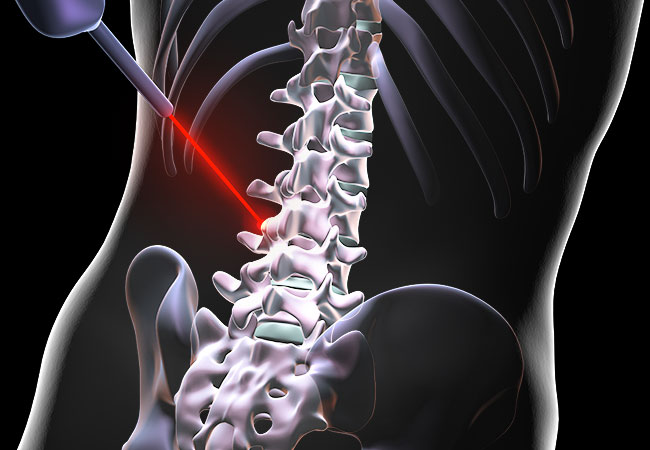 Features Of Spine Surgery And Top Spine Surgeons In India